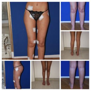 Liposuccion WAL par Bodyjet membres inférieures - Dr N.Zwillinger Paris France